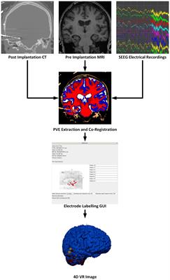 SEEG4D: a tool for 4D visualization of stereoelectroencephalography data